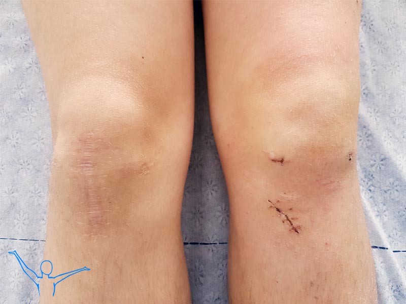 Rekonstrukcja ACL metody rehabilitacji fizjoterapi
